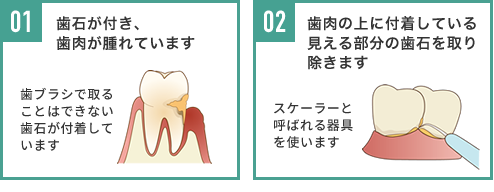 01,歯石が付き、歯肉が腫れています 02,歯肉の上に付着している見える部分の歯石を取り除きます