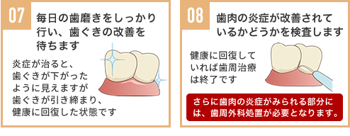 07,毎日の歯磨きをしっかり行い、歯ぐきの改善を待ちます 08,歯肉の炎症が改善されているかどうかを検査します