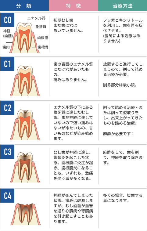 むし歯の分類と治療法