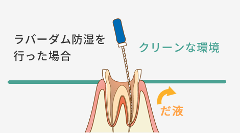 ラバーダム防湿を行った場合