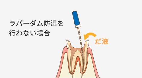 ラバーダム防湿を行わない場合