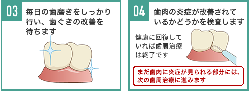 03,毎日の歯磨きをしっかり行い、歯ぐきの改善を待ちます 04,歯肉の炎症が改善されているかどうかを検査します