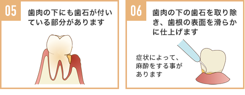 05,歯肉の下にも歯石が付いている部分があります 06.歯肉の下の歯石を取り除き、歯根の表面を滑らかに仕上げます